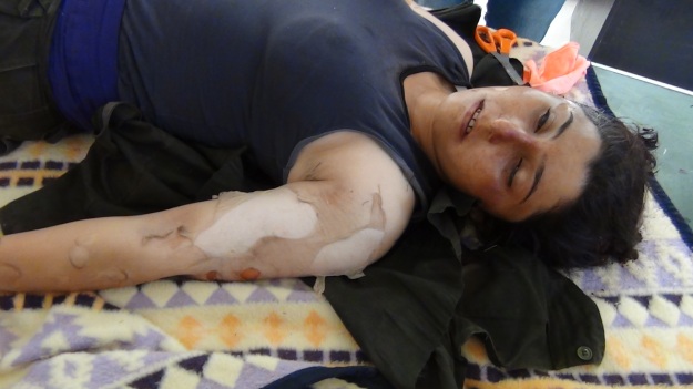 A Kurd allegedly hit with chemical weapons by the Islamic State in Kobani